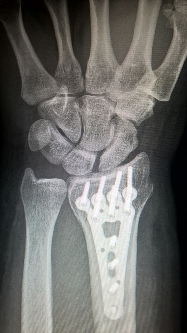 fisioterapia post intervento